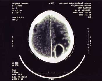 脳のレントゲン写真
